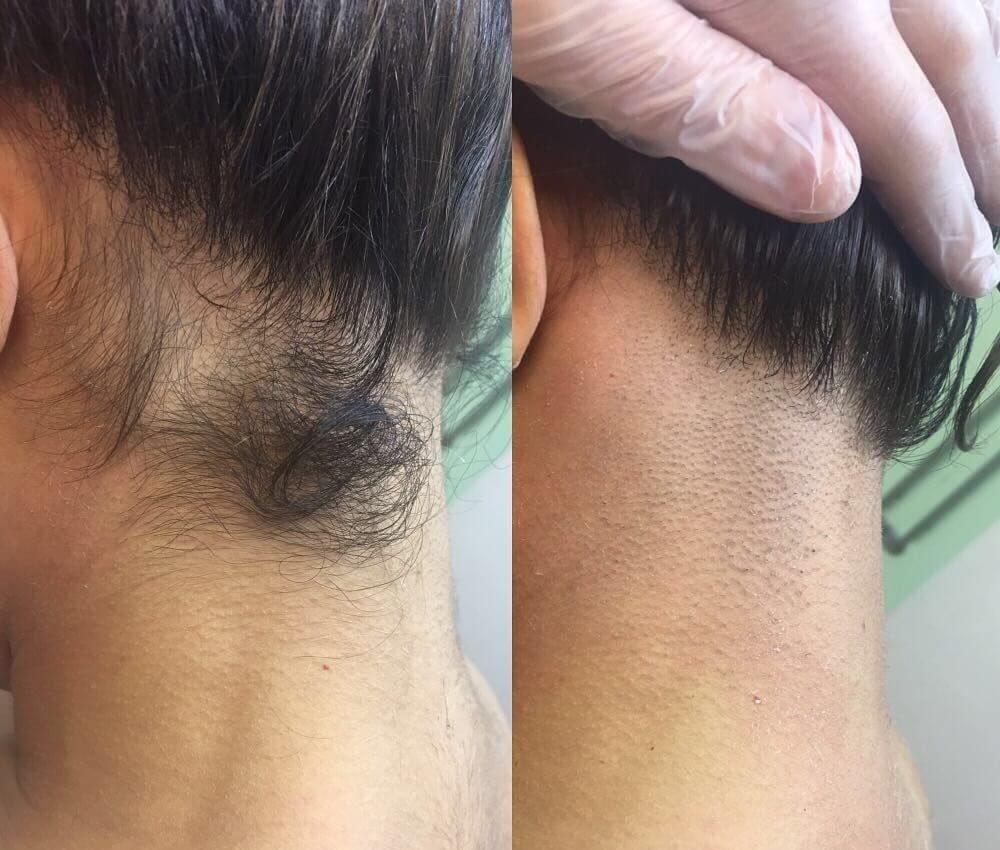 Фото до та після видалення волосся апаратом Zemits Zarion