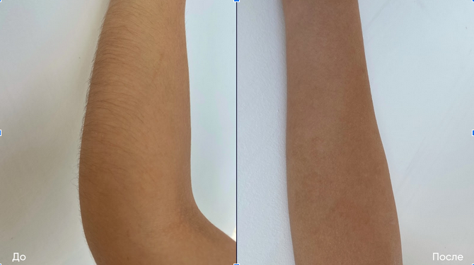 фото до та після лазерної епіляції на руках