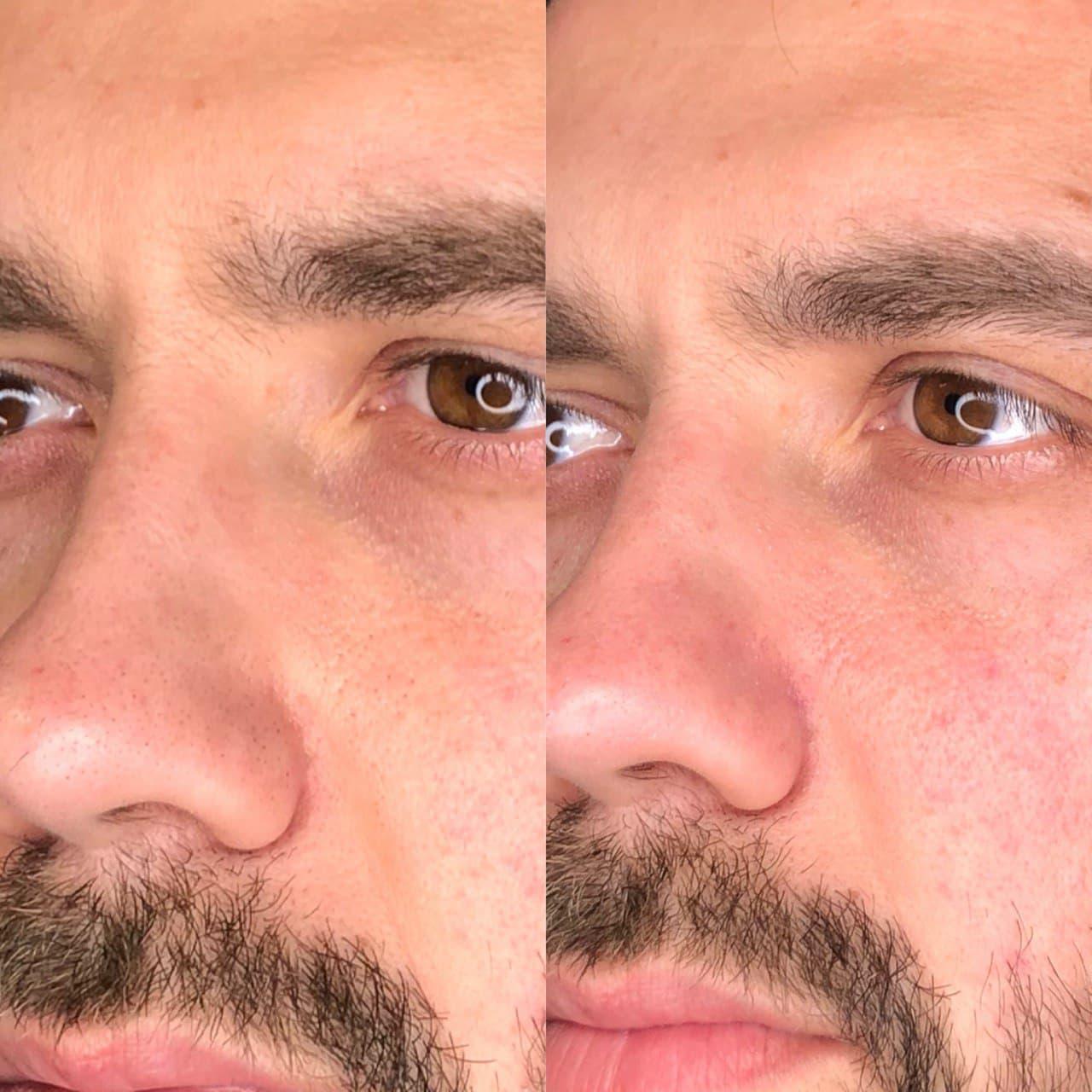 Фото до и после процедуры на аппарате Zemits Sante